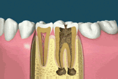 ever_seen_a_root_canal_surgery.gif