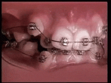 how_braces_work.gif