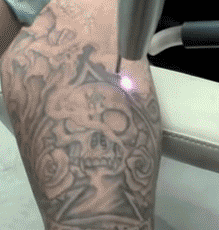 laser_tattoo_removal.gif