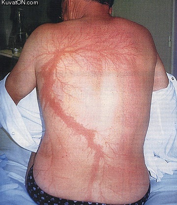 lightning_strike_victim.jpg