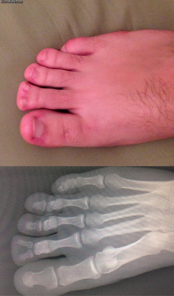 polydactyly.jpg