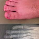 polydactyly.jpg